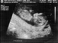 ultrasound.gif